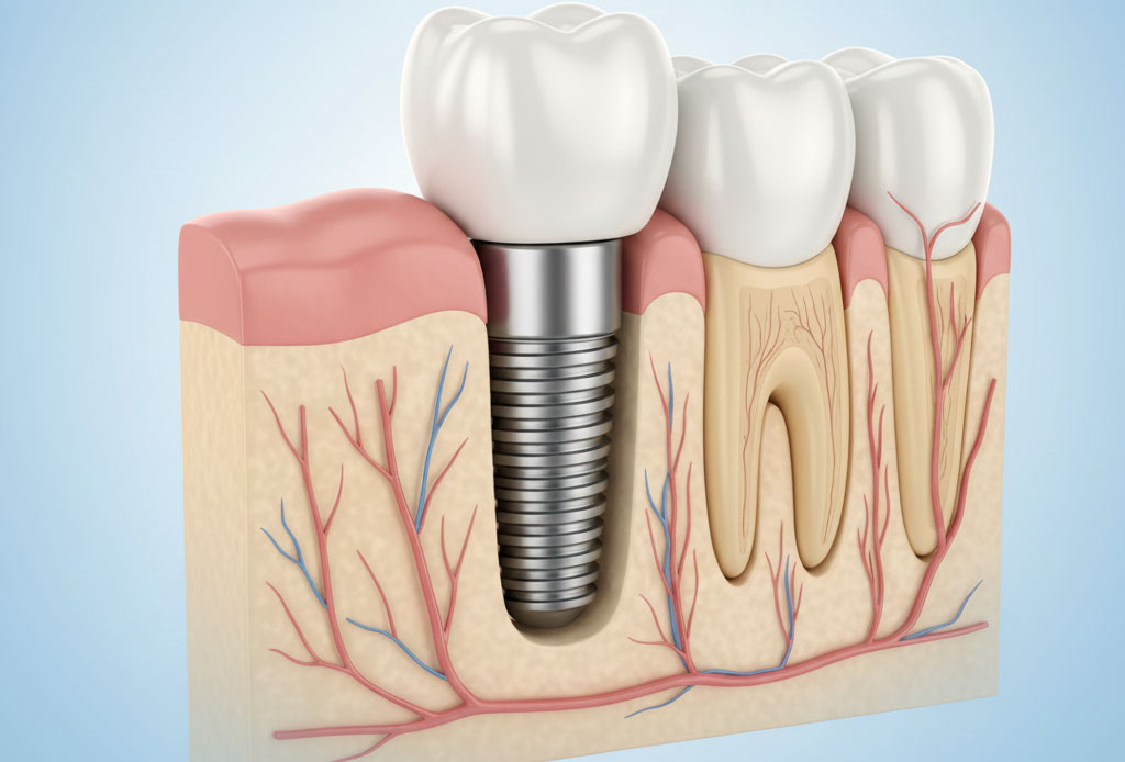 MR Dental - Implantologija - Astra Tech implantni sistem